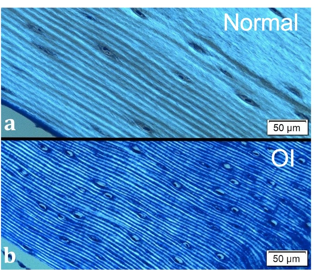 Histological images of normal and OI bone. The normal bone has lamealla (lines of bone) that are thicker than the OI bone.
